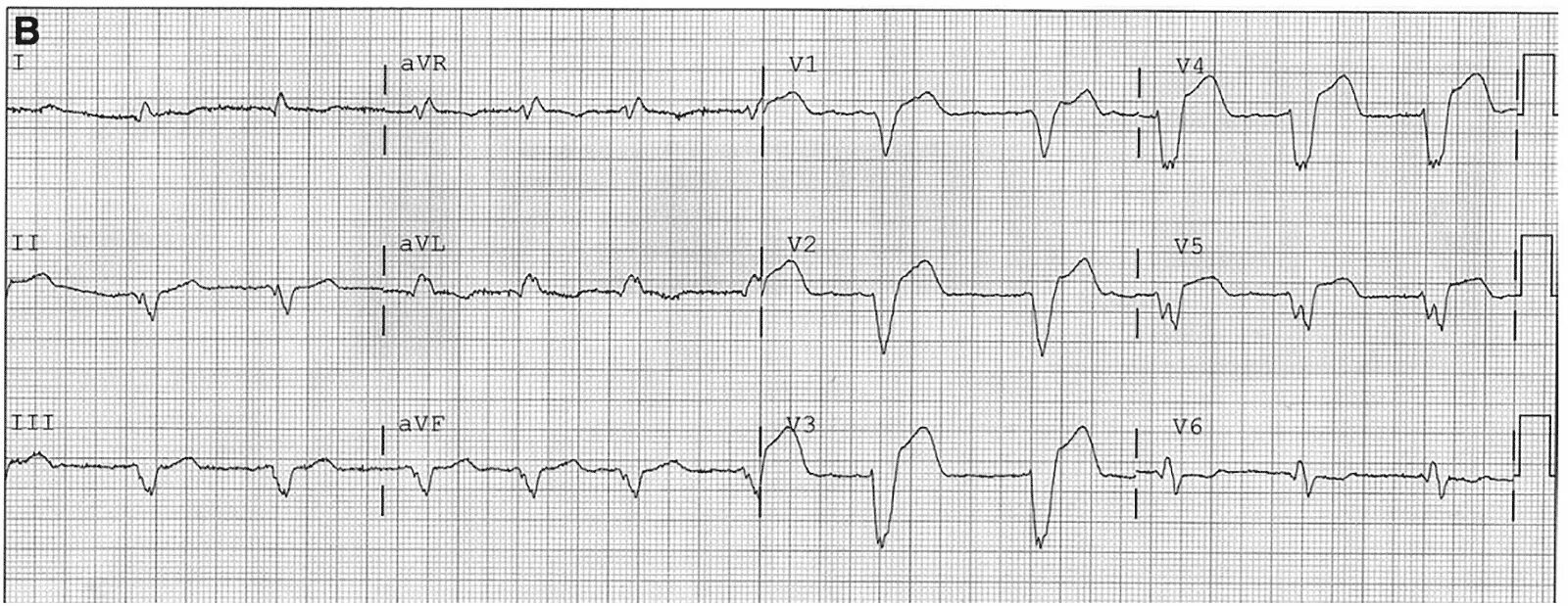 Элевация сегмента St в AVR. STEMI на ЭКГ. AVR инфаркт ЭКГ. Аневризма аорты на ЭКГ. Отведение v1 на экг