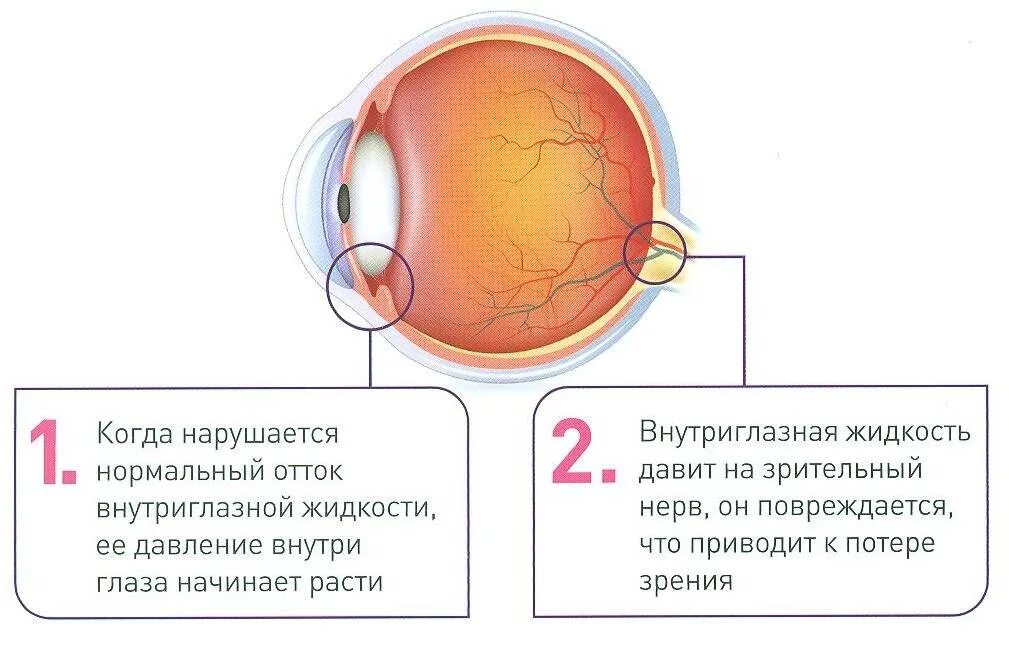 Высокое глазное давление. Строение глаза глаукома. какая часть глаза поддерживает внутриглазное давление. глаукома внутриглазное давление жидкость. повышение внутриглазного давления.