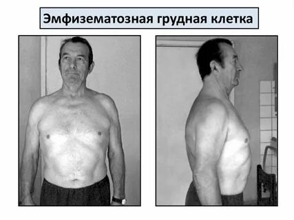 Грудная эмфизема