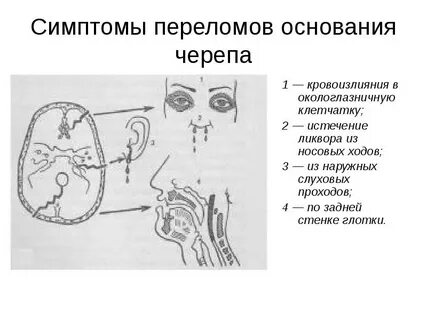 Переломы задней черепной ямки