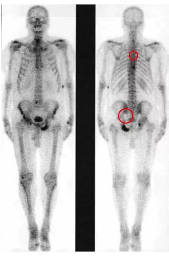 Метастазы в кости при раке предстательной. Остеосцинтиграфия метастазы. Сцинтиграфия костей метастазы. Метастазы в костях при сцинтиграфии. Остеосцинтиграфия метастазы в костях.