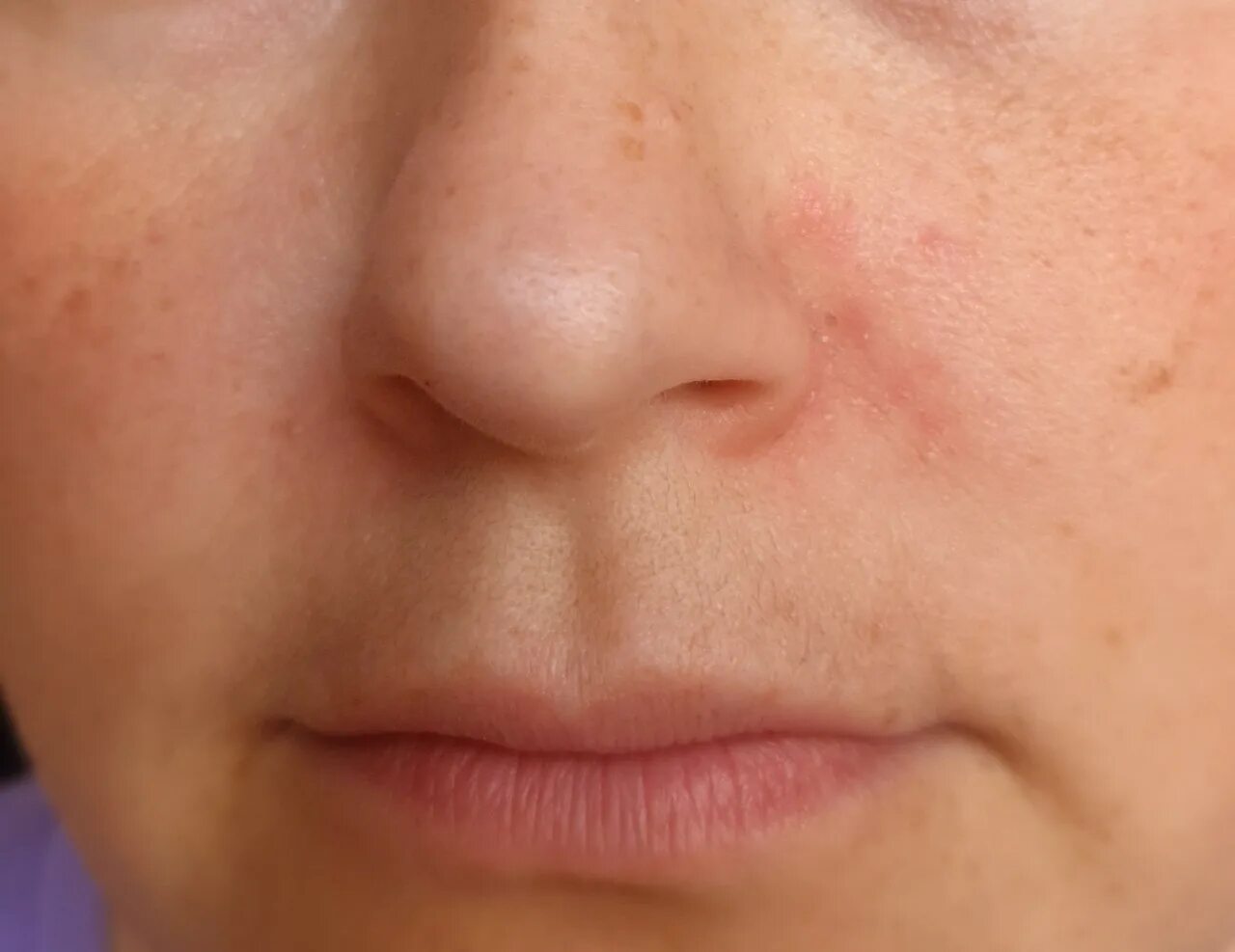 Seb Derm or Rosacea?