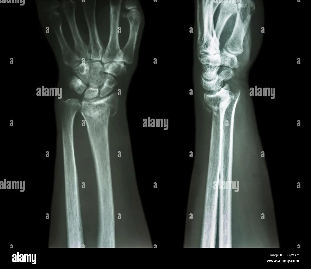 Radius fracture