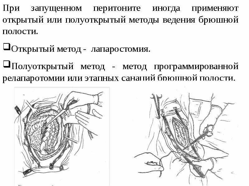 Перитонит после операции на кишечнике. Диагноз перитонит. перитонит этапы операции.