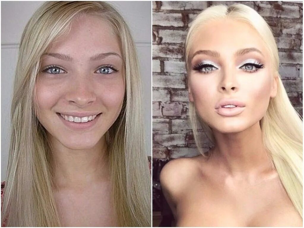 Девушки до и после пластики. Валерия лукьянова до операции. Синди кимберли селфи. Тимати и алена шишкова. Пластика красивых девушек.