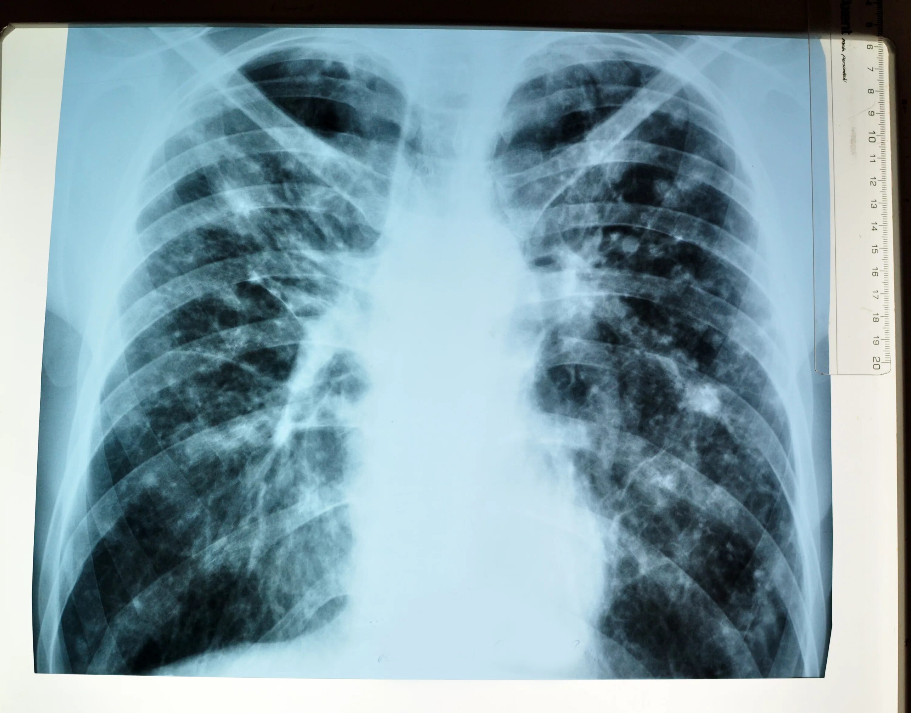 Туберкулез tuberculosis. Открыиая форма туберкулёза. Открытая форма туберкулеза.