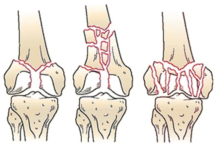 Перелом мыщелка локтевого сустава. Переломы мыщелков бедренной кости. Перелом большеберцовой кости в коленном суставе. Эпифизарный внутрисуставной перелом схема.