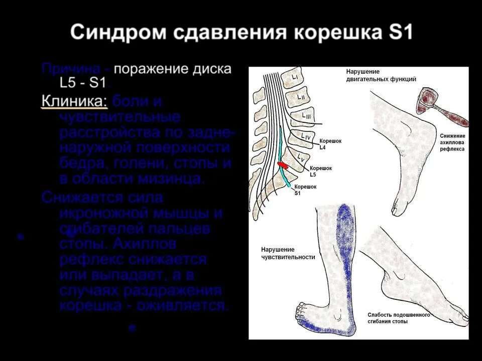 Корешковое поражение. Синдром сдавления корешка l4. Радикулопатия s1 Корешков. Корешок л4 иннервация. Иннервация Корешков позвоночника.