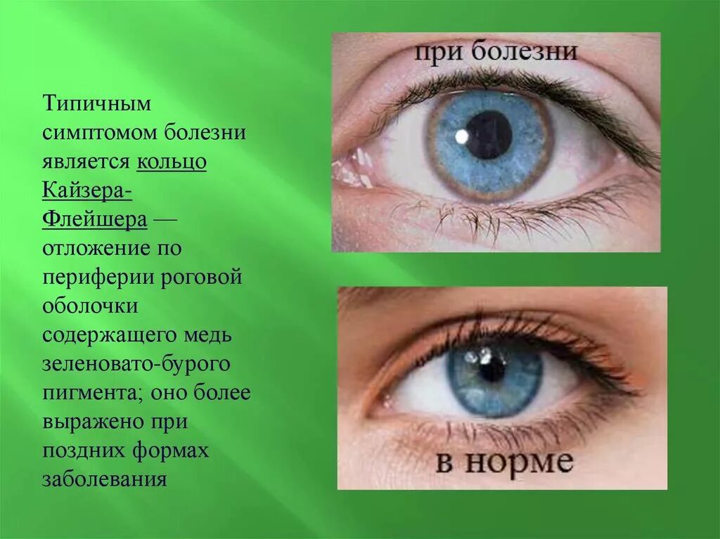 Синдром вильсона коновалова что это такое простыми. Кольцо Кайзера Флейшера. Болезнь Вильсона Коновалова кольца Кайзера-Флейшера. Зеленовато бурое кольцо Кайзера-Флейшера. Болезнь Вильсона Коновалова глаза.