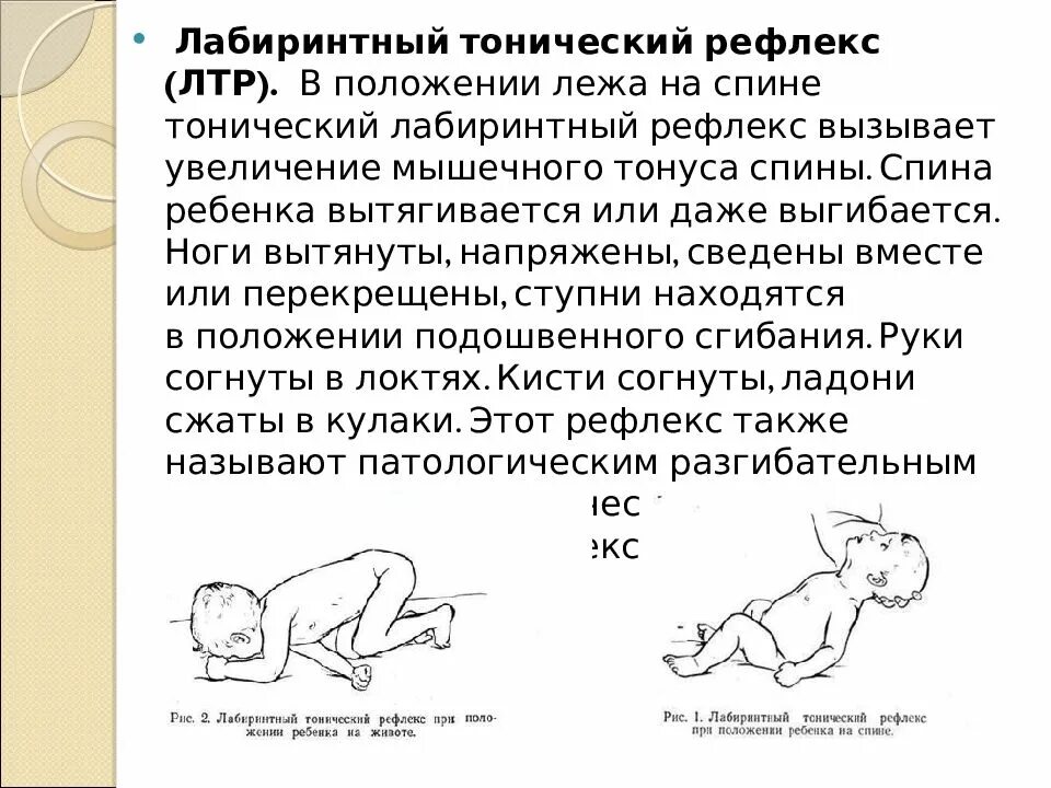 Лабиринт тонический рефлекс при ДЦП. Лабиринтный тонический рефлекс новорожденного. Симметричный шейный тонический рефлекс. Тонический рефлекс - лабиринтный тонический рефлекс (лтр).