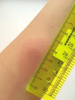 Манту ребенку годик