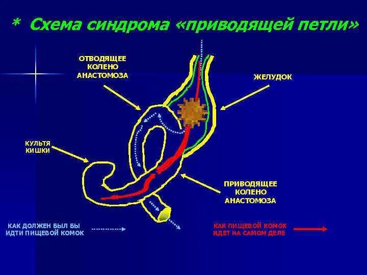 Синдром приводящей петли. Демпинг синдром и синдром приводящей петли. Синдром приводящей петли стадии. Понятие порочного круга синдрома приводящей петли. Синдром приводящей петли.