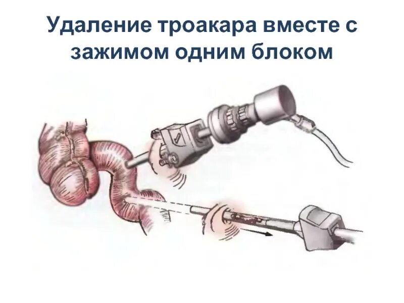 Аппендицит через сколько выписывают. Лапароскопическая аппендицит аппендэктомия. видеолапароскопическая аппендэктомия. лапароскопическая аппендэктомия троакары. троакар для лапароскопии.