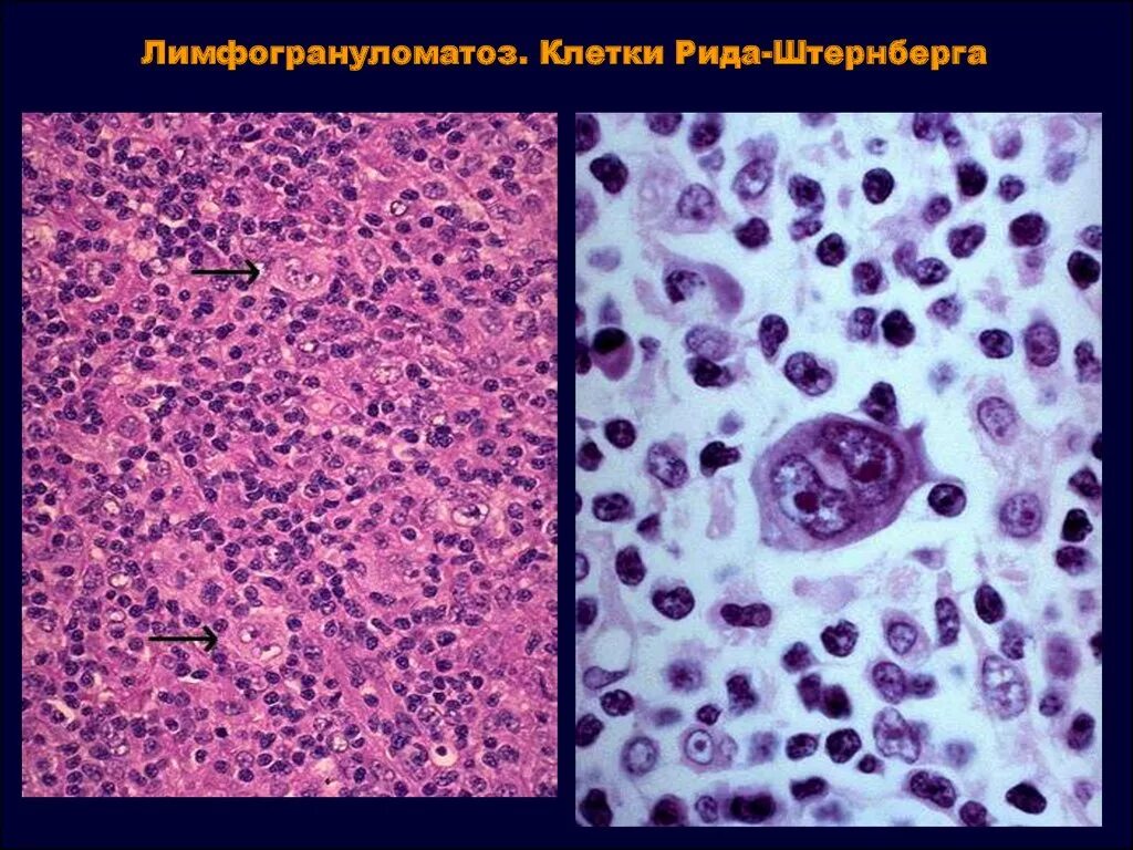 Клетки Рида Березовского Штернберга. Лимфома Ходжкина клетки Березовского-Штернберга-Рид. Клетки Березовского-Штернберга гистология. Клетки Рида – Штернберга препарат. Лимфоидная опухоль