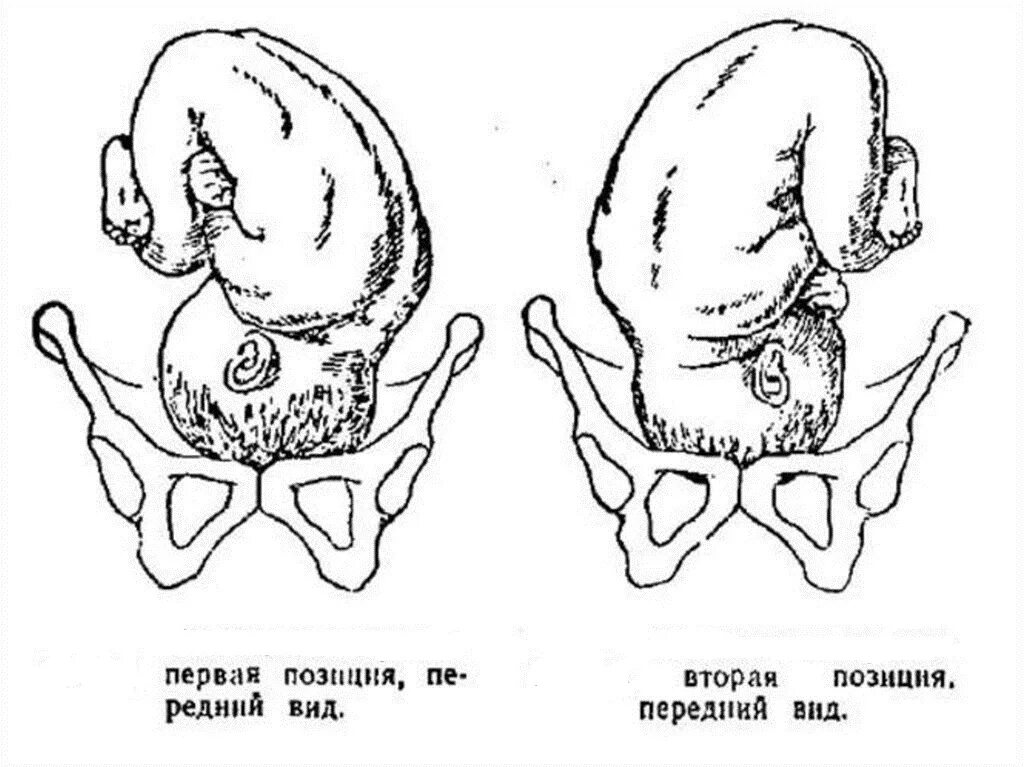 Позиция плода в акушерстве. Затылочное предлежание плода передний вид. 1 Позиция передний вид затылочного предлежания. Затылочное предлежание передний вид 2 позиция. Передний и задний вид затылочного предлежания.