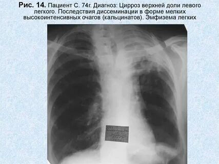 Очаг в верхней доле левого легкого