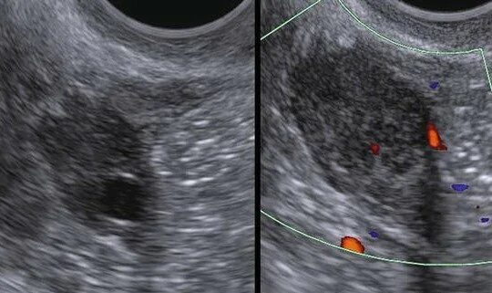 Как называется узи яичников. Карцинома яичников узи. Как называется узи яичников. Фолликулярная киста яичника на узи. Гранулезоклеточная опухоль яичников узи.