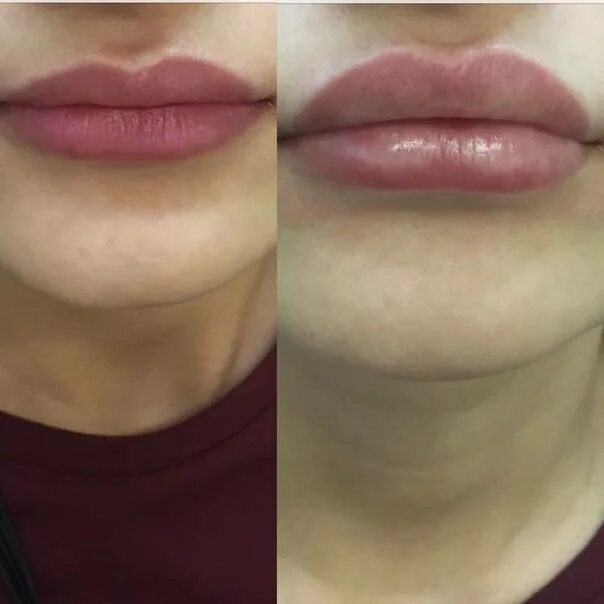 Через сколько после увеличения губ можно пить. Накачивание губ гиалуроновой кислотой 1 мл. Памятка после увеличения губ. Увеличение губ гиалуроновой кислотой. Контурная пластика губ гиалуроновой кислотой 1 мл.