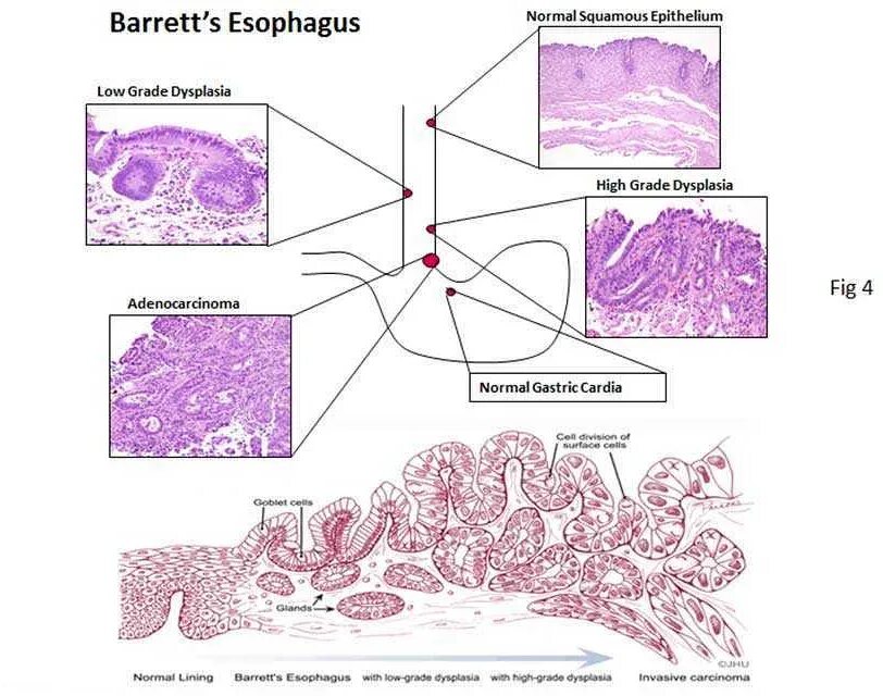 Grade в онкологии. High grade дисплазии. High grade дисплазии. Остеогенная саркома гистология. High grade дисплазии.
