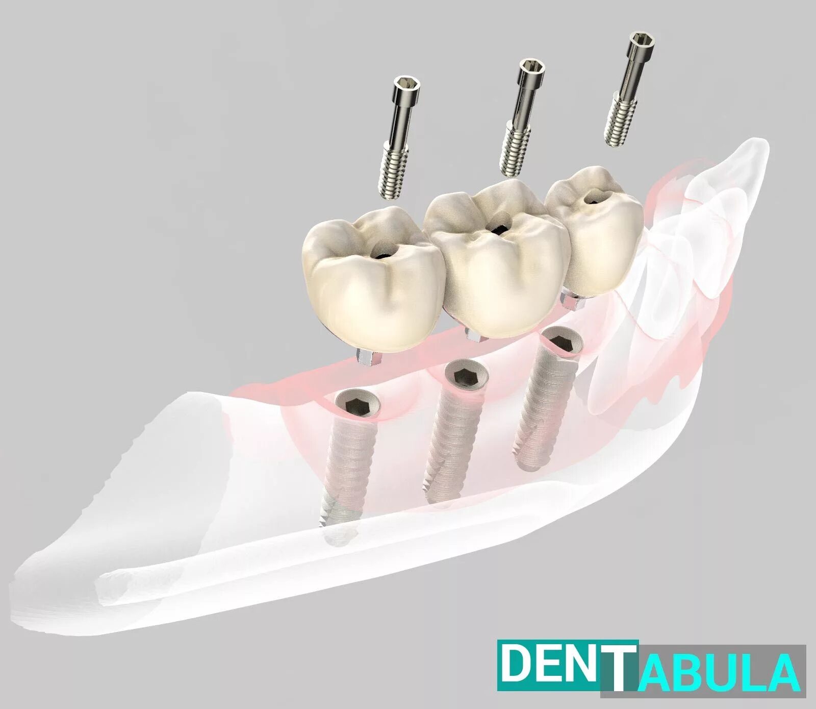 Абатмент винтовой фиксации. Имплант коронка обтюратор. Зубные имплантаты стелс. Пины в стоматологии