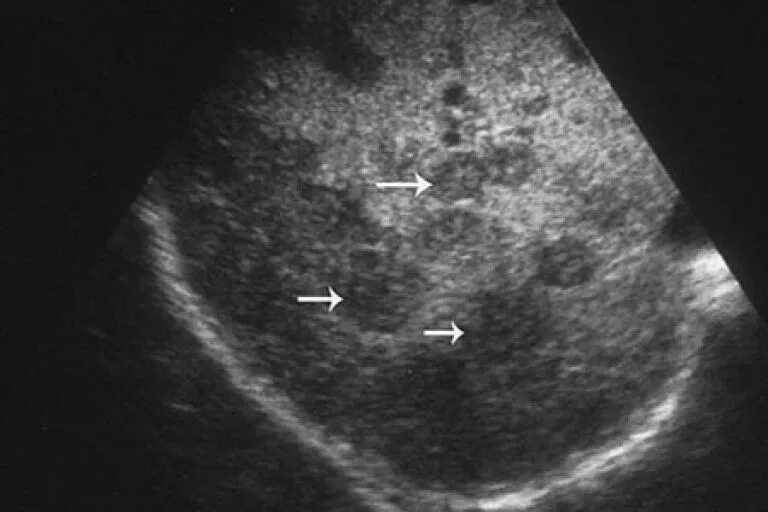 Диффузно очаговые образования. Диффузное поражение печени УЗИ. Жировой гепатоз печени на УЗИ. Очаговая дистрофия печени на УЗИ. Очаговый жировой гепатоз на УЗИ.
