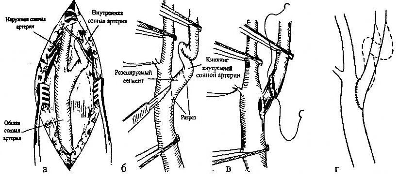 Перевязка общей и наружной сонной артерии. Устье ВСА сонной артерии. Операция на сонной артерии при извитости. Операции при аневризмах общей сонной артерии. Операция на артерии шеи