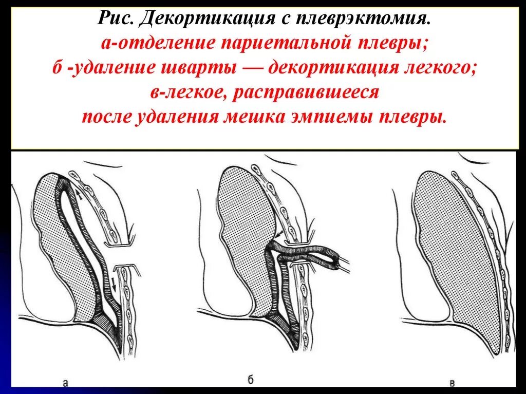 Плевра операция. Декортикация и плеврэктомия. Операция делорма при эмпиеме плевры. Плевра операция. Декортикация легкого по делорму.