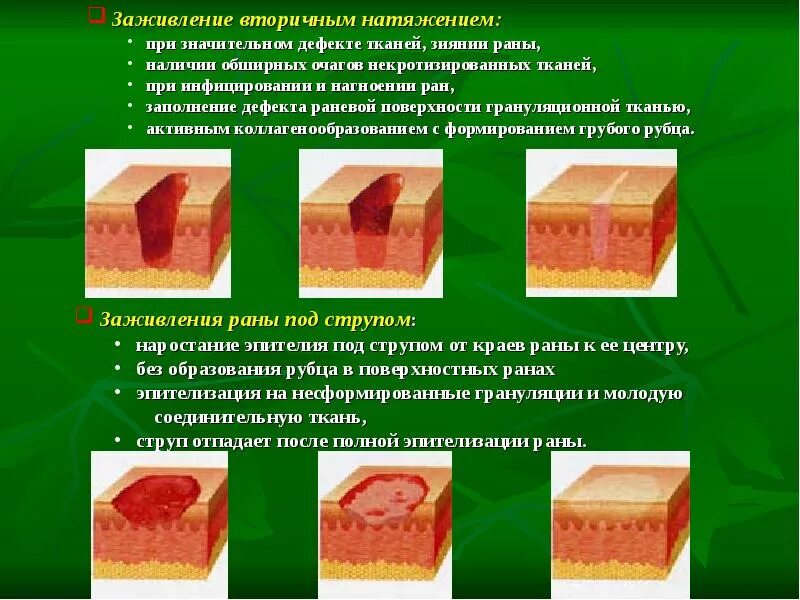 Стадии заживления после. Этапы вторичного заживления РАН. Общая хирургия заживление РАН вторичным натяжением. Раны заживающие вторичным натяжением примеры. Зажившение вторичныс наиядением.