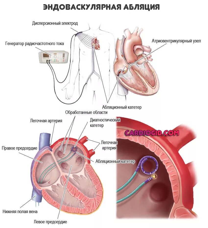 Радиочастотная аблация аритмий сердца. Радиочастотная катетерная абляция методика проведения. Аритмия сердца РЧА операция. Абляция сердца операция РЧА. Изоляция легочных вен