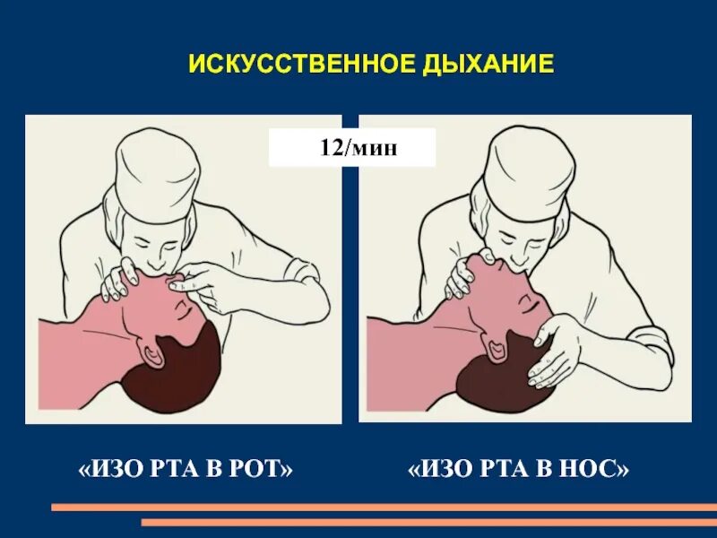 Эффективное искусственное дыхание. Искусственное дыхание рот в нос. Приемы искусственного дыхания.