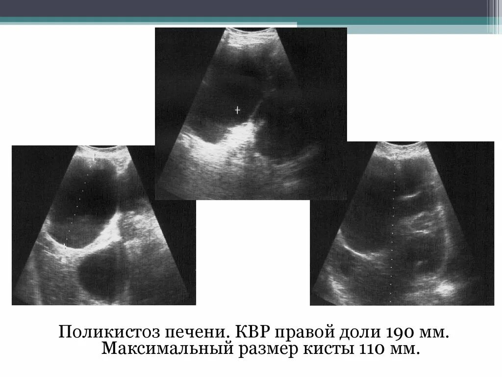 Квр печени увеличена. Киста левой доли печени на УЗИ. КВР печени по УЗИ.