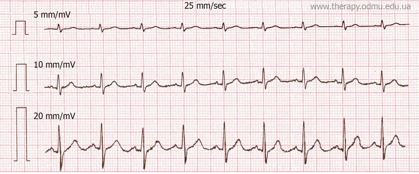 Мв на экг. Контрольный милливольт на ЭКГ. 10 Мм/МВ В ЭКГ. МВ В мм на ЭКГ. 0 1 МВ на ЭКГ.