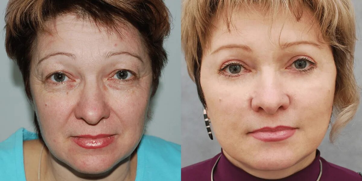 Блефаропластика - Многопрофильная клиника ElleClinic (Эль Клиник)