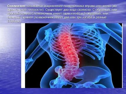 Сколиозом называется
