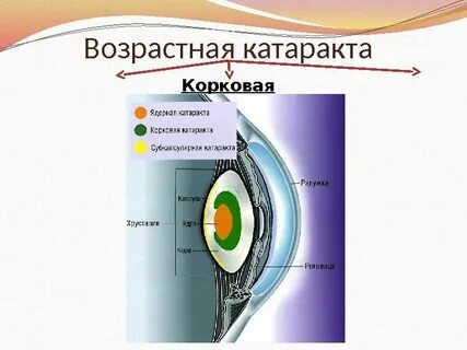 Возрастная катаракта