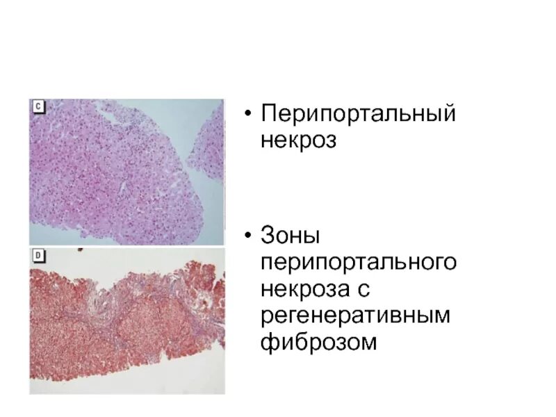 Перипортальная фиброз. Моноцеллюлярный некроз. Фиброз печени гистология. Перипортальный некроз.