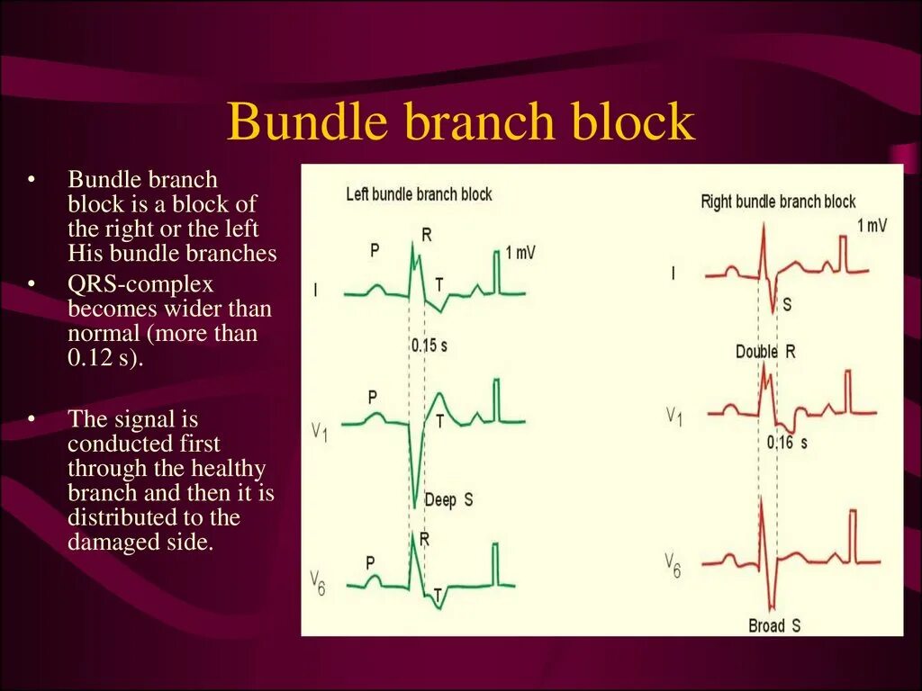 Bundle Branch Block. Left Bundle Branch Block ECG. Right Bundle Branch Block. ECG right Branch Bundle Block.