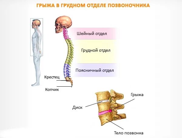 Спинной форум. Грыжа грудного отдела позвоночника симптомы. Грыжа позвонка грудного отдела. Симптомы спинной грыжи грудного отдела позвоночника. Межпозвоночная грыжа грудного отдела позвоночника.