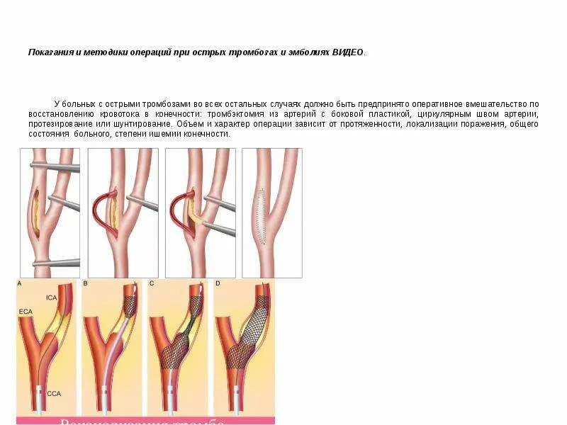 Тромбоз артерии лечение. Артериальные тромбозы позвоночной артерии. Эмболии и тромбозы магистральных артерий конечностей. Острый тромбофлебит подколенной артерии. Эмболия магистральных артерий конечностей. Профилактика..