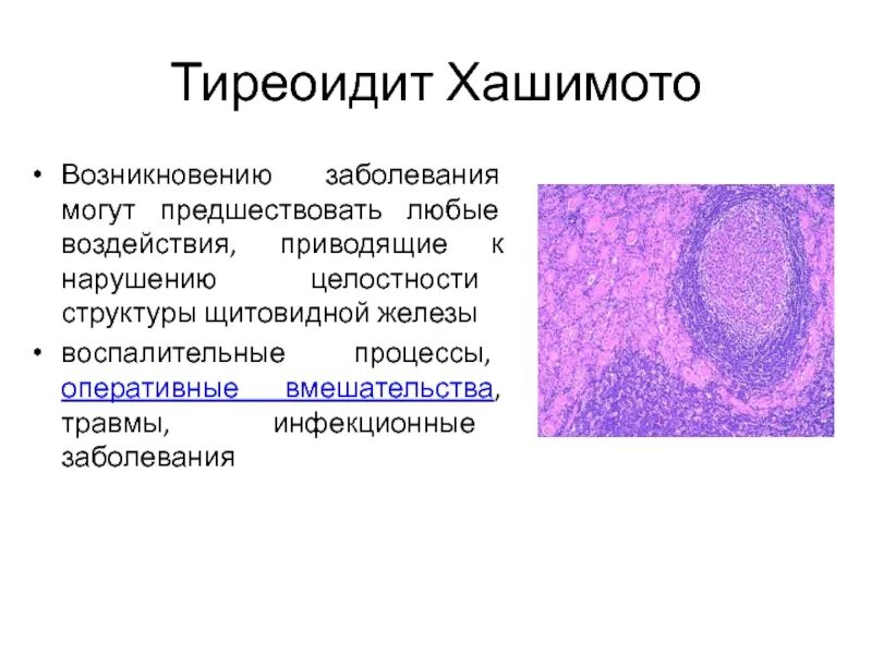 Хронический аутоиммунный тиреоидит гистология. Зоб Хашимото гистология. Тиреоидит Хашимото патанатомия. Аутоиммунный тиреоидит Хашимото микропрепарат патанатомия.