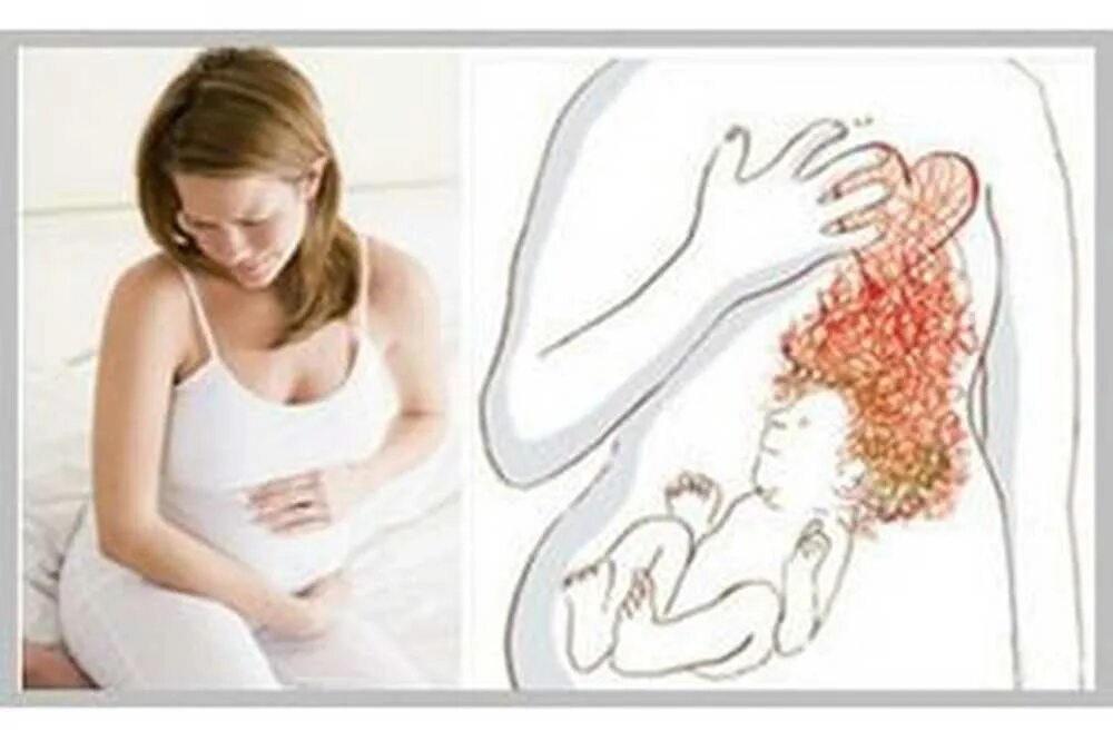Болит желудок второй триместр. Изжога при беременности первый триместр. При изжоге при беременности. Изжога у беременных на ранних сроках. Изжога и тошнота при беременности.