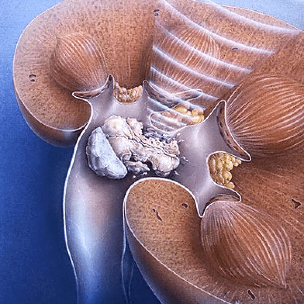 Камни в почках заболевание. Мочекаменная болезнь конкременты. Коралловый нефролитиаз. Почечнокаменная болезнь камни. Мочекаменная болезнь камни в почках.