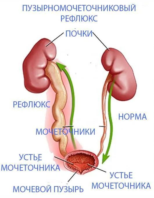 Рефлюкс мочеточника. Устье мочеточника в мочевом пузыре. Почечно мочеточниковый рефлюкс. Мочеточниково-пузырный рефлюкс. Пузырно почечный рефлюкс.