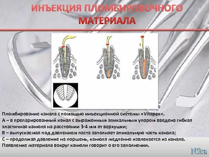 Временное пломбирование корневых каналов. Неполное пломбирование корневого канала. Постоянное пломбирование корневых каналов. Инъекционный метод пломбирования корневого канала. Методы контроля качества пломбирования корневых каналов.