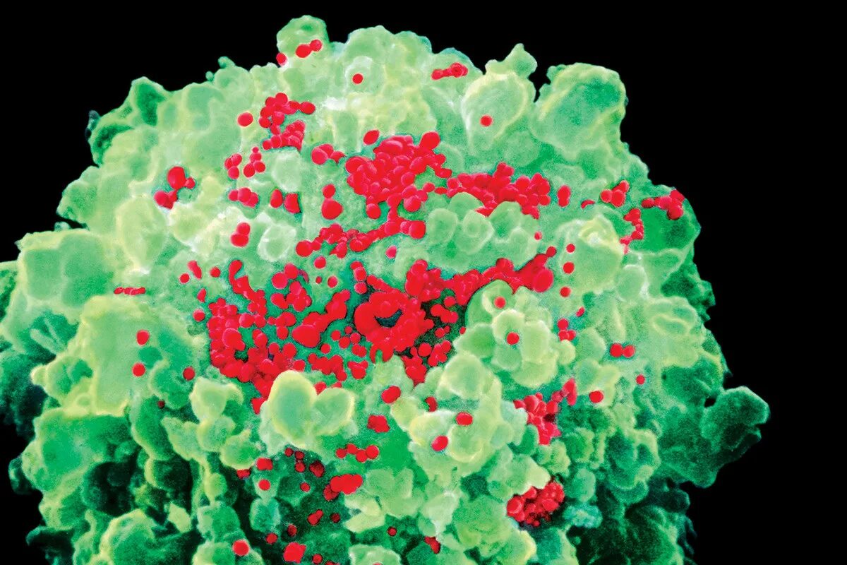 Кровь на иммунодефицит. Вирус Эпштейна-Барр микроскоп. Вирус Эпштейна Барр иммунодефицит. Инфицированная клетка ВИЧ.