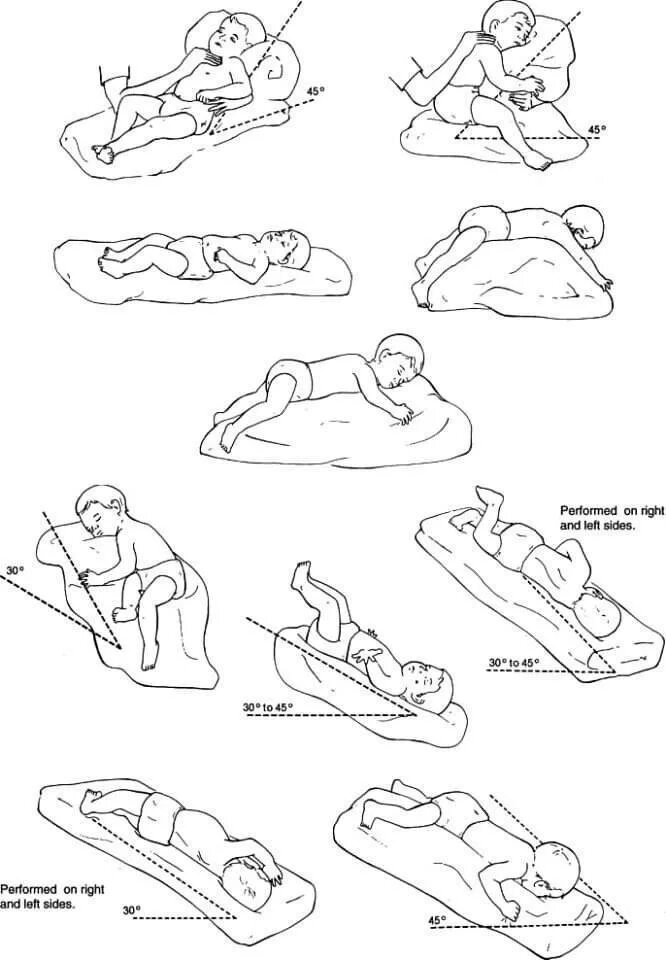 Постуральный дренаж грудничку. Постуральный дренаж для детей до года. Постуральный (позиционный) дренаж у детей. Постуральный дренаж бронхоэктатической болезни.