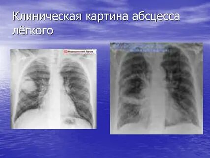 Абсцесс легкого клинические