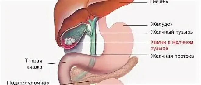 Толстый желчный пузырь. Камни в жёлчном пузыре питание. Диета при камнях в желчном.