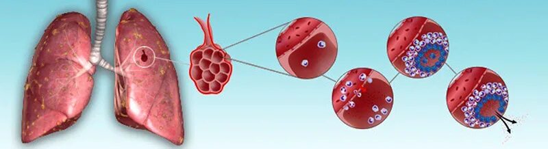 Tuberculosis disease. Легкие больного туберкулезом. Tuberculosis ава. Tuberculosis disease. Types of tb.