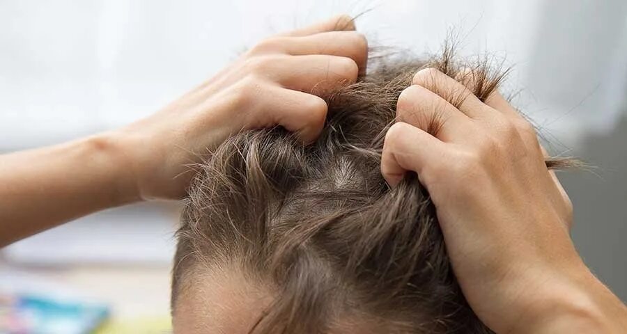 Эпидемия вшей. Педикулез на светлых волосах. Педикулез на светлых волосах. Педикулез волосистой части головы. Эпидемия вшей.